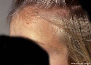 nevoid-hyperpigmentation
