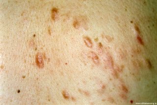 piloleiomyoma