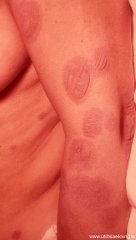 regnbogaroasott-erythema-multiforme