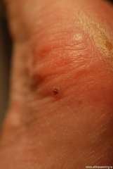 sarkmein-kaposis-kaposis-sarcoma