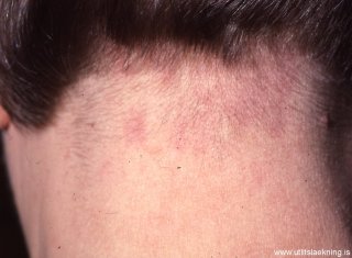 storkbit-nevus-flammeus-nuchae-erythema-nuchae-ea-storkbite