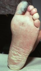 sykursykisdrep-diabetes-gangrene