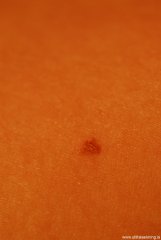 vellus-hair-cyst