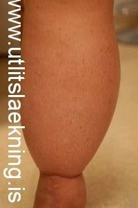 vessabjugur-lymphedema-ea-lymphoedema-300x2001-e1370869580966