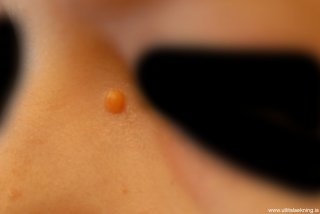 xanthogranuloma
