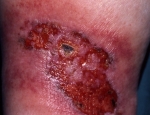 abolga-sjogrens-sjogrens-vasculitis