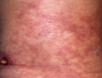 abolgusar-vasculitis-ulcer