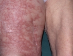 asarkmein-angiosarcoma
