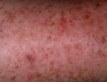 epidermolysis-dysplasia-verruciformis