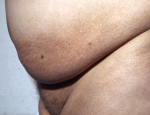 husortnun-melanosis-vegna-myrarkoldu-malaria-og-raormasyki-filariasis