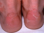 inherited-epidermolysis-bullosa-ser-grein-enginn-texti