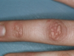 knuckle-pads