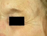 laser-ellivortur-mynd01-eftir