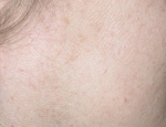 laser-ellivortur-mynd02-eftir