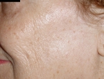 laser-gegnblettum-mynd01-eftir
