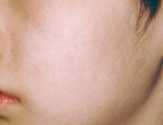 laser-gegnblettum-mynd03-eftir