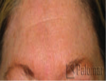 laser-gegnblettum-mynd09-eftir
