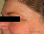 laser-gegnblettum-mynd10-eftir