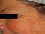 laser-gegnblettum-mynd10-fyrir