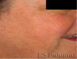 laser-gegnblettum-mynd11-eftir