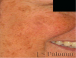 laser-gegnblettum-mynd11-fyrir