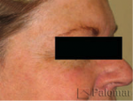 laser-gegnblettum-mynd12-eftir