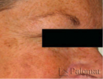 laser-gegnblettum-mynd12-fyrir