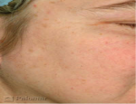 laser-gegnblettum-mynd13-eftir