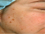 laser-gegnblettum-mynd13-fyrir