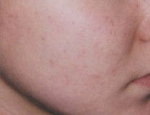 laser-gegnbolum-mynd01-eftir
