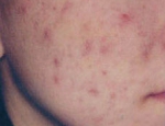 laser-gegnbolum-mynd01-fyrir