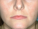 laser-gegnbolum-mynd02-eftir