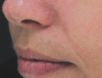 laser-gegnbolum-mynd04-eftir