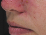 laser-gegnbolum-mynd04-fyrir