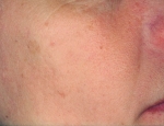 laser-gegnbolum-mynd05-eftir