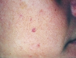 laser-gegnbolum-mynd05-fyrir