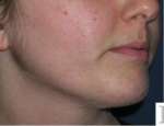 laser-gegnbolum-mynd06-eftir