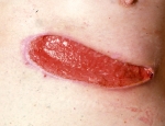 legusar-pressure-ulcer