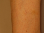 leukocytoclastic-vasculitis