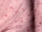 lichenoid-lyfjasvorun-drug-lichenoid-toxicodermatitis