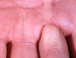 lofakreppa-dupuytrens-contracture