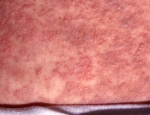 meinvorp-fra-ristli-colon-metastasis