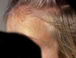nevoid-hyperpigmentation