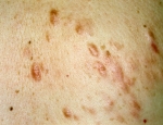 piloleiomyoma