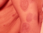 regnbogaroasott-erythema-multiforme