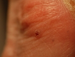 sarkmein-kaposis-kaposis-sarcoma