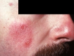 stabundinn-helluroi-discoid-lupus-erythematosus