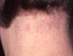 storkbit-nevus-flammeus-nuchae-erythema-nuchae-ea-storkbite