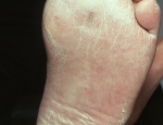 sykursykisdrep-diabetes-gangrene