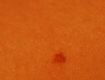 vellus-hair-cyst